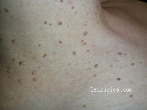 verrugas-de-cuello-fibroepiteliomas-dr-lauzurica-dermatc3b3logo-www-lazurica-wordpress-com