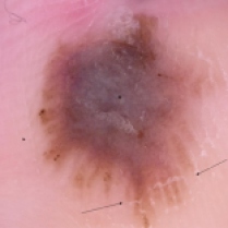 Dermatoscopia. Patrón paralelo de la cresta (flechas), puntos marrón oscuro de distribución asimétrica y velo azul-blanquecino (asterisco)