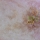 Casos en dermatoscopia  26/03 _ Lesión pigmentada en la frente _ Respuesta